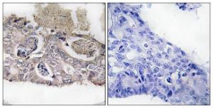 Immunohistochemical analysis of paraffin-embedded human colon carcinoma tissue using Anti-MARK2 Antibody The right hand panel represents a negative control, where the antibody was pre-incubated with the immunising peptide