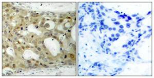 Immunohistochemical analysis of paraffin-embedded human breast carcinoma tissue using Anti-BCL-2 Antibody. The right hand panel represents a negative control, where the Antibody was pre-incubated with the immunising peptide