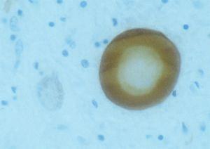 Immunohistochemical staining of lewy body in Parkinson's diseased human brain tissue using sheep polyclonal to human alpha synuclein, catalogue number BSENS-075-50.