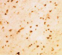 Immunohistochemical staining (paraffin-embedded tissue) of glial inclusions in white matter from a case of multiple system atrophy using sheep polyclonal to human alpha synuclein, catalogue number BSENS-075-50.