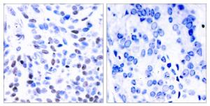 Immunohistochemical analysis of paraffin-embedded human breast carcinoma tissue using Anti-NF kappa B p100 / p52 Antibody. The right hand panel represents a negative control, where the antibody was pre-incubated with the immunising peptide.