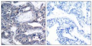 Immunohistochemical analysis of paraffin-embedded human breast carcinoma using Anti-MEK2 (phospho Thr394) Antibody. The right hand panel represents a negative control, where the antibody was pre-incubated with the immunising peptide.