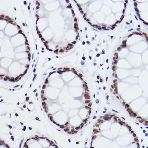 Immunohistochemistry analysis of paraffin-embedded human colon carcinoma tissue using Anti-MED4 Antibody [ARC2528] (A306502) at a dilution of 1:100 (40x lens). Perform high pressure antigen retrieval with 10 mM citrate buffer pH 6.0 before commencing with IHC staining protocol.