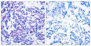 Immunohistochemical analysis of paraffin-embedded human breast carcinoma using Anti-JunD (phospho Ser255) Antibody. The right hand panel represents a negative control, where the antibody was pre-incubated with the immunising peptide