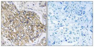 Immunohistochemical analysis of paraffin-embedded human breast carcinoma tissue using Anti-LPHN2 Antibody. The right hand panel represents a negative control, where the antibody was pre-incubated with the immunising peptide