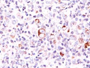 Immunohistochemical analysis of formalin-fixed, paraffin-embedded Hodgkin's lymphoma using Anti-Bcl-X Antibody [SPM165]