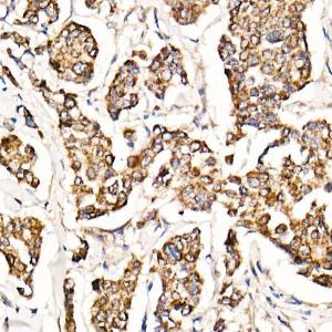 Immunohistochemistry analysis of paraffin-embedded human breast cancer tissue using Anti-MyD88 Antibody [ARC52507] (A306508) at a dilution of 1:1000 (40X lens). Perform high pressure antigen retrieval with 10 mM citrate buffer pH 6.0 before commencing with IHC staining protocol