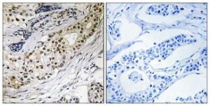 Immunohistochemical analysis of paraffin-embedded human colon carcinoma tissue using Anti-LAMA3 Antibody. The right hand panel represents a negative control, where the antibody was pre-incubated with the immunising peptide