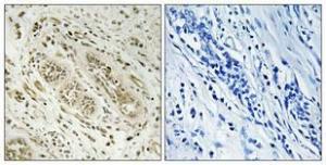 Immunohistochemical analysis of paraffin-embedded human breast cancer using Anti-BCAR3 Antibody 1:100 (4 °C overnight). The right hand panel represents a negative control, where the Antibody was pre-incubated with the immunising peptide