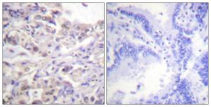 Immunohistochemical analysis of paraffin-embedded human lung carcinoma using Anti-hnRPD (phospho Ser83) Antibody The right hand panel represents a negative control, where the antibody was pre-incubated with the immunising peptide