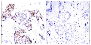 Immunohistochemical analysis of paraffin-embedded human breast carcinoma using Anti-Elk1 (phospho Ser389) Antibody. The right hand panel represents a negative control, where the antibody was pre-incubated with the immunising peptide.