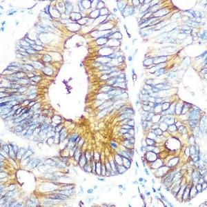 Immunohistochemistry analysis of paraffin-embedded human colon carcinoma tissue using Anti-Aquaporin 1 Antibody [ARC0925] (A306513) at a dilution of 1:100 (40x lens)