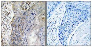 Immunohistochemical analysis of paraffin-embedded human lung carcinoma tissue using Anti-SLC28A2 Antibody The right hand panel represents a negative control, where the antibody was pre-incubated with the immunising peptide