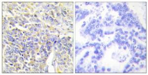 Immunohistochemical analysis of paraffin-embedded human lung carcinoma tissue using Anti-KAD1 Antibody . The right hand panel represents a negative control, where the antibody was pre-incubated with the immunising peptide.