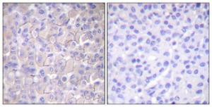 Immunohistochemical analysis of paraffin-embedded human breast carcinoma using Anti-EGFR (phospho Thr693) Antibody. The right hand panel represents a negative control, where the Antibody was pre-incubated with the immunising peptide