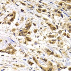 Immunohistochemistry analysis of paraffin-embedded human breast cancer tissue using Anti-MAGEA1 Antibody (A11838) at a dilution of 1:200 (40X lens). Perform microwave antigen retrieval with 10 mM PBS buffer pH 7.2 before commencing with IHC staining protocol