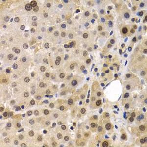 Immunohistochemistry analysis of paraffin-embedded human liver cancer using Anti-MAGEA1 Antibody (A11838) at a dilution of 1:200 (40X lens). Perform microwave antigen retrieval with 10 mM PBS buffer pH 7.2 before commencing with IHC staining protocol