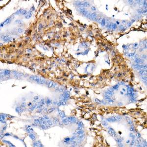 Immunohistochemistry analysis of paraffin-embedded human colon carcinoma tissue using Anti-Vimentin Antibody [ARC0086] (A305554) at a dilution of 1:50(40X lens). Perform microwave antigen retrieval with 10 mM PBS buffer pH 7.2 before commencing with IHC staining protocol