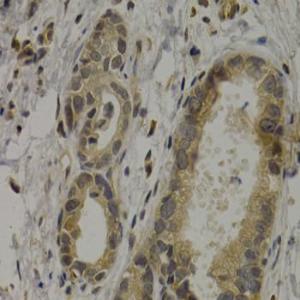 Immunohistochemistry analysis of paraffin-embedded human stomach cancer using Anti-MAGEA1 Antibody (A11838) at a dilution of 1:200 (40X lens). Perform microwave antigen retrieval with 10 mM PBS buffer pH 7.2 before commencing with IHC staining protocol