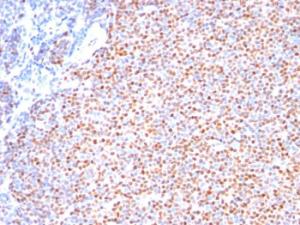 Immunohistochemical analysis of formalin-fixed, paraffin-embedded human mantle cell lymphoma using Anti-Cyclin D1 Antibody [SPM587]