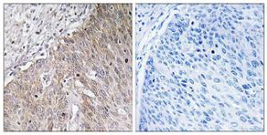 Immunohistochemical analysis of paraffin-embedded human cervix carcinoma tissue using Anti-APOL2 Antibody The right hand panel represents a negative control, where the antibody was pre-incubated with the immunising peptide