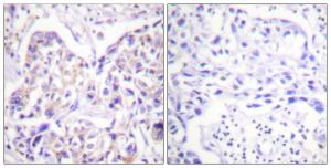 Immunohistochemical analysis of paraffin-embedded human breast carcinoma tissue using Anti-IRS-1 Antibody. The right hand panel represents a negative control, where the antibody was pre-incubated with the immunising peptide.