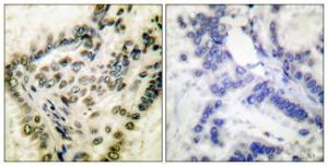 Immunohistochemical analysis of paraffin-embedded human lung carcinoma using Anti-CREB (phospho Ser142) Antibody. The right hand panel represents a negative control, where the antibody was pre-incubated with the immunising peptide