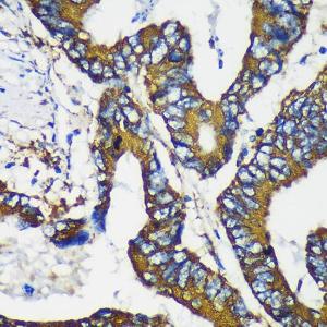 Immunohistochemistry analysis of paraffin-embedded human colon cancer using Anti-MEK4/MKK4 Antibody (A306529) at a dilution of 1:100 (40x lens) Perform microwave antigen retrieval with 10 mM PBS buffer pH 72 before commencing with IHC staining protocol