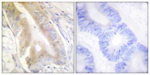 Immunohistochemical analysis of paraffin-embedded human colon carcinoma tissue using Anti-IREB1 Antibody. The right hand panel represents a negative control, where the Antibody was pre-incubated with the immunising peptide