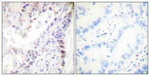 Immunohistochemical analysis of paraffin-embedded human lung cancer using Anti-CREB (phospho Ser142) Antibody 1:100 (4°C overnight). The right hand panel represents a negative control, where the antibody was pre-incubated with the immunising peptide