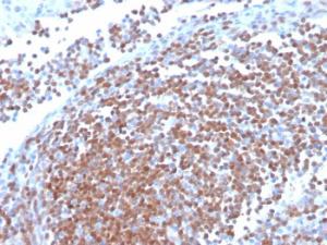 Immunohistochemical analysis of formalin-fixed, paraffin-embedded human mantle cell lymphoma using Anti-Cyclin D1 Antibody [CCND1/3370R]