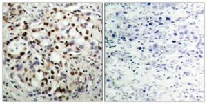 Immunohistochemical analysis of paraffin-embedded human breast carcinoma using Anti-CREB (phospho Ser133) Antibody. The right hand panel represents a negative control, where the antibody was pre-incubated with the immunising peptide