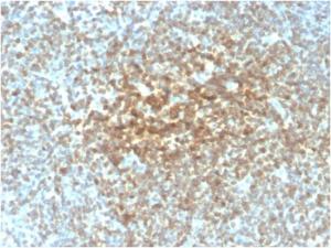 Immunohistochemical analysis of formalin-fixed, paraffin-embedded human follicular lymphoma using Anti-Bcl-2 Antibody [rBCL2/782]