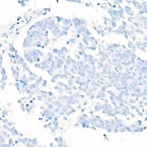 Immunohistochemistry analysis of paraffin-embedded human lung squamous carcinoma tissue(negative control samples) using Anti-TTF1 Antibody [ARC51284] (A306550) at a dilution of 1:1000 (40x lens)