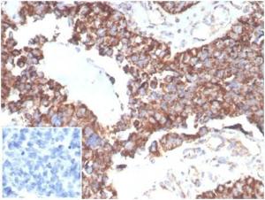 Immunohistochemical analysis of formalin-fixed, paraffin-embedded human ovarian carcinoma tissue using Anti-TREM2 Antibody [TREM2/7210]. Inset: PBS instead of the primary antibody. Secondary antibody negative control.