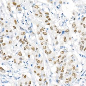 Immunohistochemistry analysis of paraffin-embedded human lung adenocarcinoma using Anti-TTF1 Antibody [ARC51284] (A306550) at a dilution of 1:1000 (40x lens)