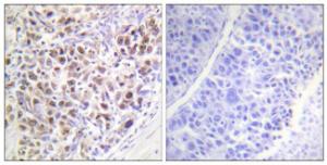 Immunohistochemical analysis of paraffin-embedded human liver carcinoma using Anti-AurB (phospho Thr232) Antibody. The right hand panel represents a negative control, where the antibody was pre-incubated with the immunising peptide