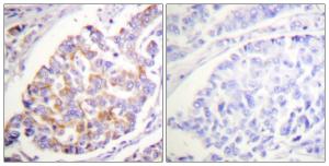 Immunohistochemical analysis of paraffin-embedded human breast carcinoma using Anti-ADD1 (phospho Ser726) Antibody The right hand panel represents a negative control, where the antibody was pre-incubated with the immunising peptide