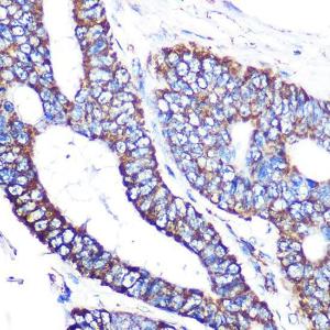 Immunohistochemistry analysis of paraffin-embedded human colon carcinoma tissue using Anti-MTCO2 Antibody [ARC0844] (A306556) at a dilution of 1:100 (40x lens). Perform microwave antigen retrieval with 10 mM PBS buffer pH 7.2 before commencing with IHC staining protocol.