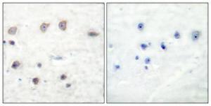 Immunohistochemical analysis of paraffin-embedded human breast cancer using Anti-ADD1 (phospho Ser726) Antibody 1:100 (4°C overnight) The right hand panel represents a negative control, where the antibody was pre-incubated with the immunising peptide