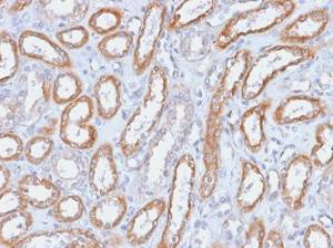 Immunohistochemical analysis of formalin-fixed, paraffin-embedded human renal cell carcinoma using Anti-Integrin beta 3 Antibody [ITGB3/2166R]