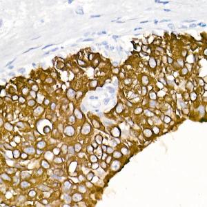 Immunohistochemistry analysis of paraffin-embedded human breast cancer tissue using Anti-Cytokeratin 19 Antibody [ARC2811] (A307943) at a dilution of 1:20 (40x lens) Perform high pressure antigen retrieval with 10 mM citrate buffer pH 60 before commencing with IHC staining protocol