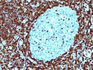 Immunohistochemical analysis of formalin-fixed, paraffin-embedded human non-Hodgkin's lymphoma using Anti-Bcl-2 Antibody [124]