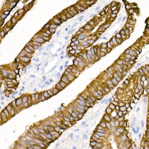 Immunohistochemistry analysis of paraffin-embedded human colon carcinoma tissue using Anti-Cytokeratin 19 Antibody [ARC2811] (A307943) at a dilution of 1:20 (40x lens) Perform high pressure antigen retrieval with 10 mM citrate buffer pH 60 before commencing with IHC staining protocol