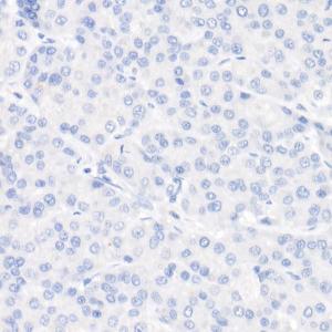 Immunohistochemistry analysis of paraffin-embedded human hepatocellular carcinoma (negative control sample) using Anti-Cytokeratin 19 Antibody [ARC2811] (A307943) at a dilution of 1:20 (40x lens)