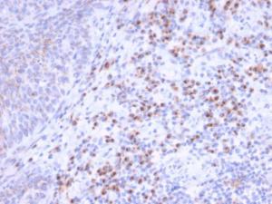 Immunohistochemical analysis of formalin-fixed, paraffin-embedded human tumor of unknown origin using Anti-RCAS1 Antibody [CPTC-EBAG9-1]