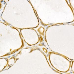 Immunohistochemistry analysis of paraffin-embedded human thyroid cancer using Anti-TRAF2 Antibody [ARC51292] (A305567) at a dilution of 1:500 (40X lens). Perform high pressure antigen retrieval with 10 mM citrate buffer pH 6.0 before commencing with IHC staining protocol