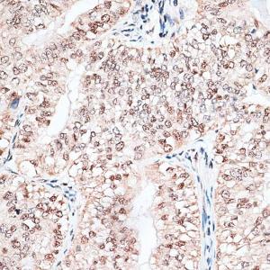 Immunohistochemistry analysis of paraffin-embedded human endometrium cancer using Anti-RBM3 Antibody (A11899) at a dilution of 1:100 (40X lens). Perform microwave antigen retrieval with 10 mM PBS buffer pH 7.2 before commencing with IHC staining protocol