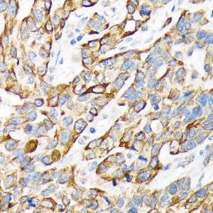 Immunohistochemistry analysis of paraffin-embedded human esophageal cancer using Anti-Cytokeratin 16/K16 Antibody [ARC1783] (A307945) at a dilution of 1:100 (40X lens). Perform microwave antigen retrieval with 10 mM Tris/EDTA buffer pH 9.0 before commencing with IHC staining protocol