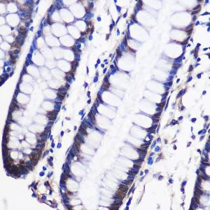 Immunohistochemistry analysis of paraffin-embedded human colon tissue using Anti-CUG-BP1 Antibody (A11903) at a dilution of 1:100 (40x lens). Perform microwave antigen retrieval with 10 mM PBS buffer pH 7.2 before commencing with IHC staining protocol.